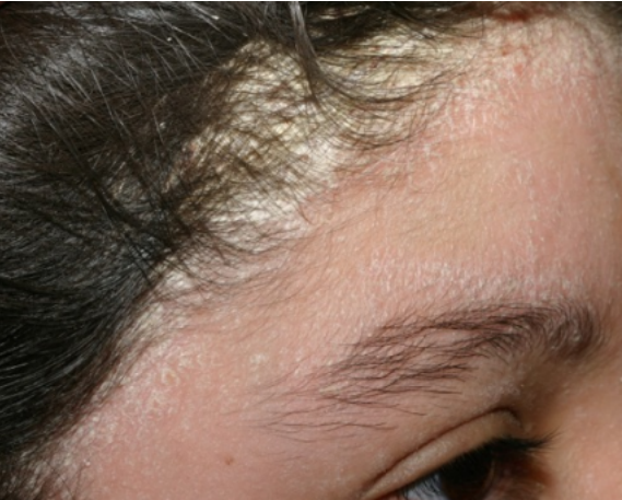 Seborrheic Dermatitis Blog Vibrant Dermatology