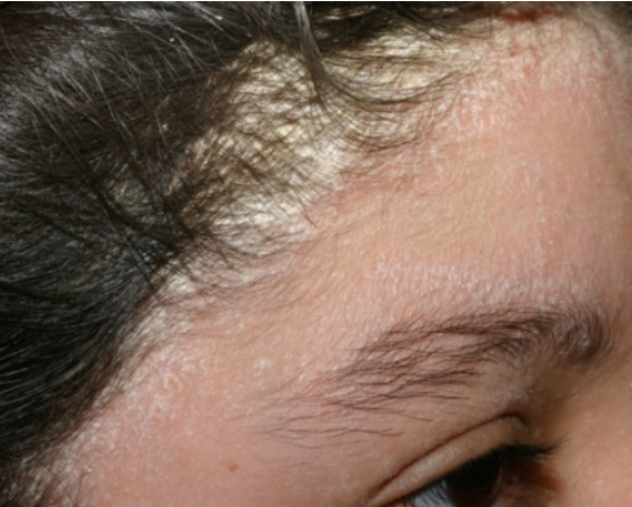 Scalp dermatitis store