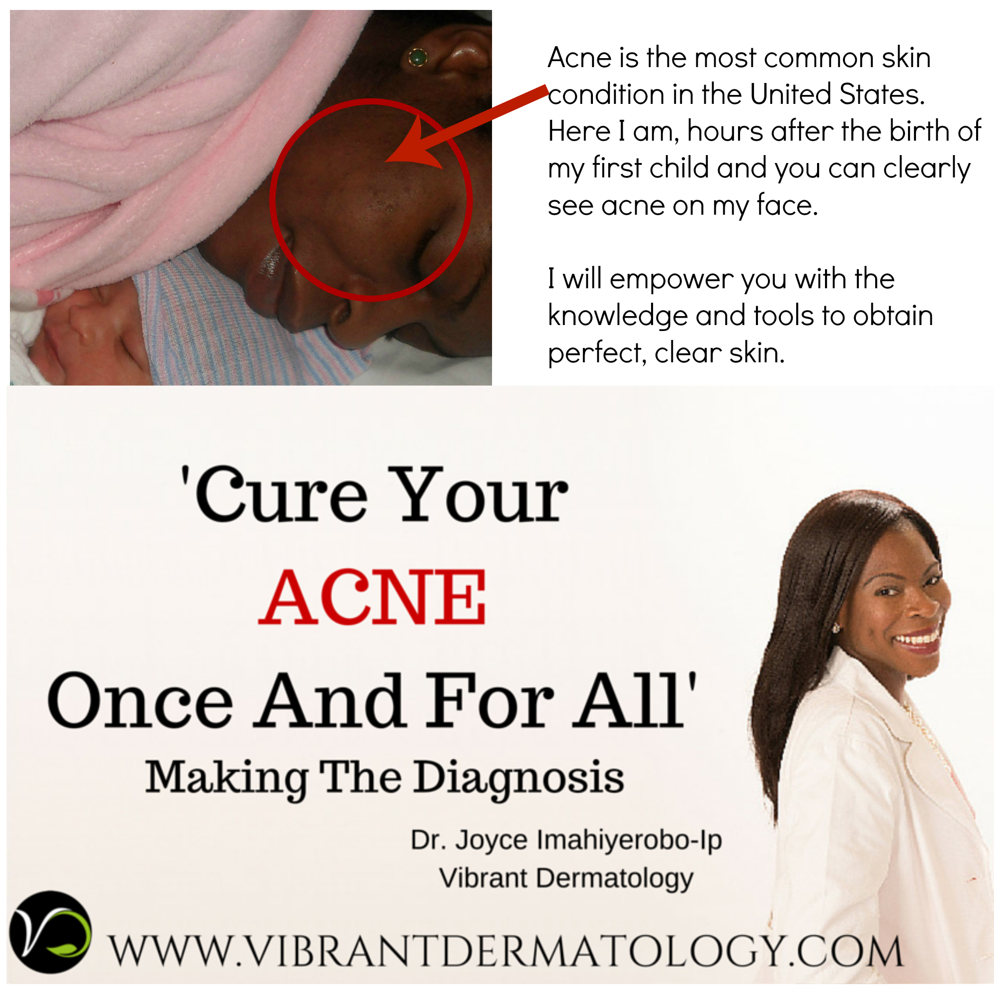 Cure Your Acne Once And For All – Making A Diagnosis - Vibrant