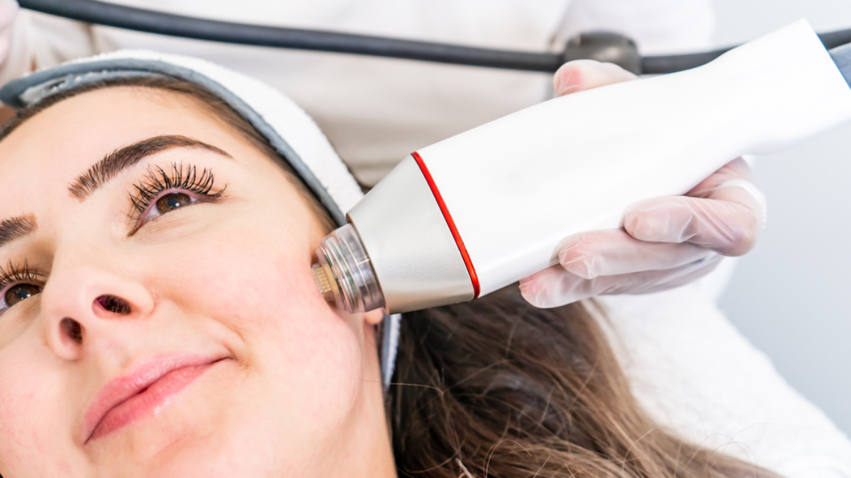 Does Microneedling With Rf Really Work Vibrant Dermatology Skinbar Md