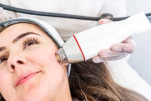 Does Microneedling With RF Really Work?