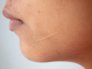 How Effective Is Scar Treatment?