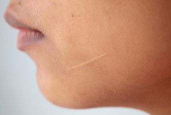 How Effective Is Scar Treatment?