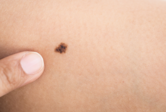 What Are the First Signs of Melanoma?