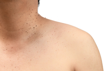 What Is the Best Way To Remove Skin Tags?
