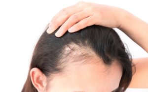 PRP Treatments Help With Hair Loss