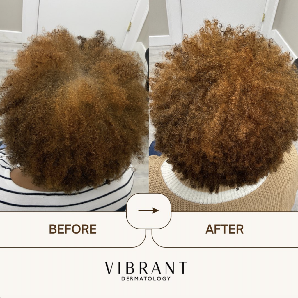 Before and after image of hair loss restoration