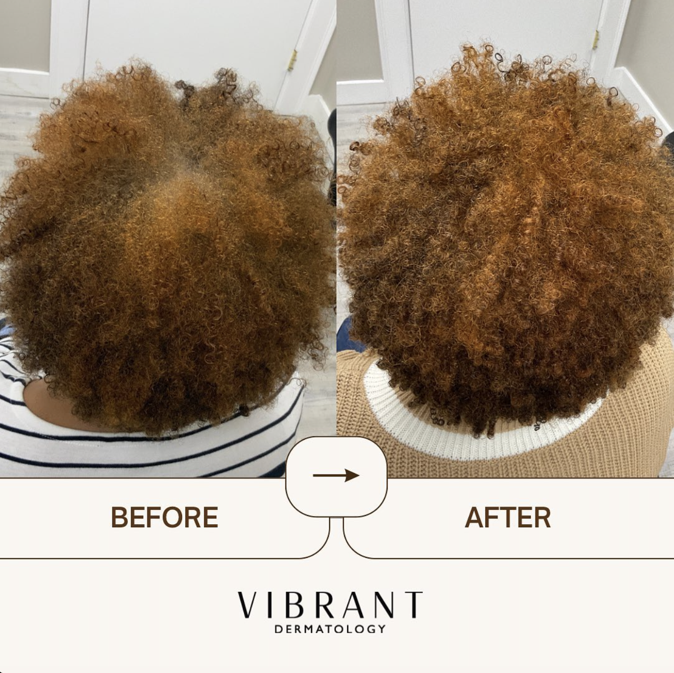 Before and after image of hair loss restoration