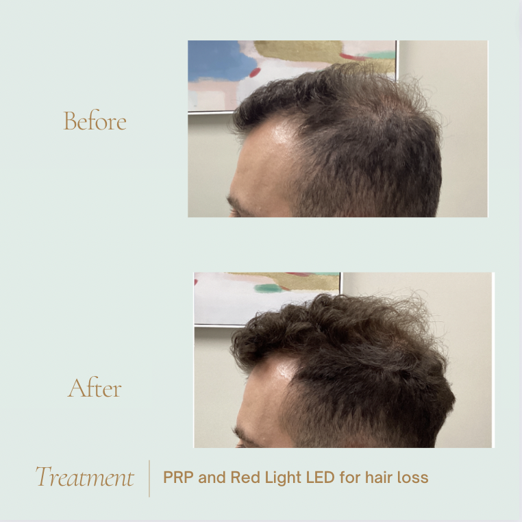 Before and After of Hair restoration