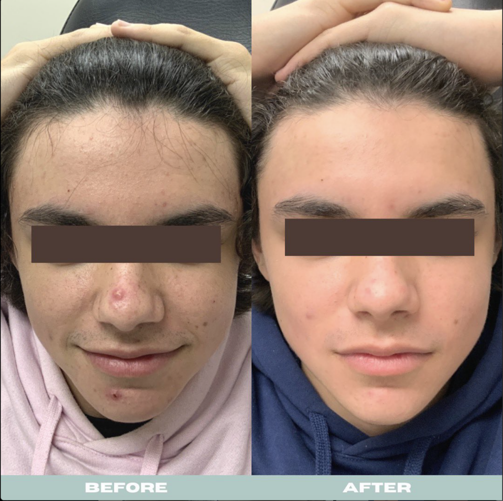 Teen Acne Before and After