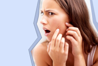 acne breakout