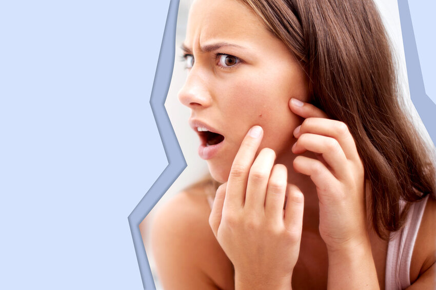 acne breakout