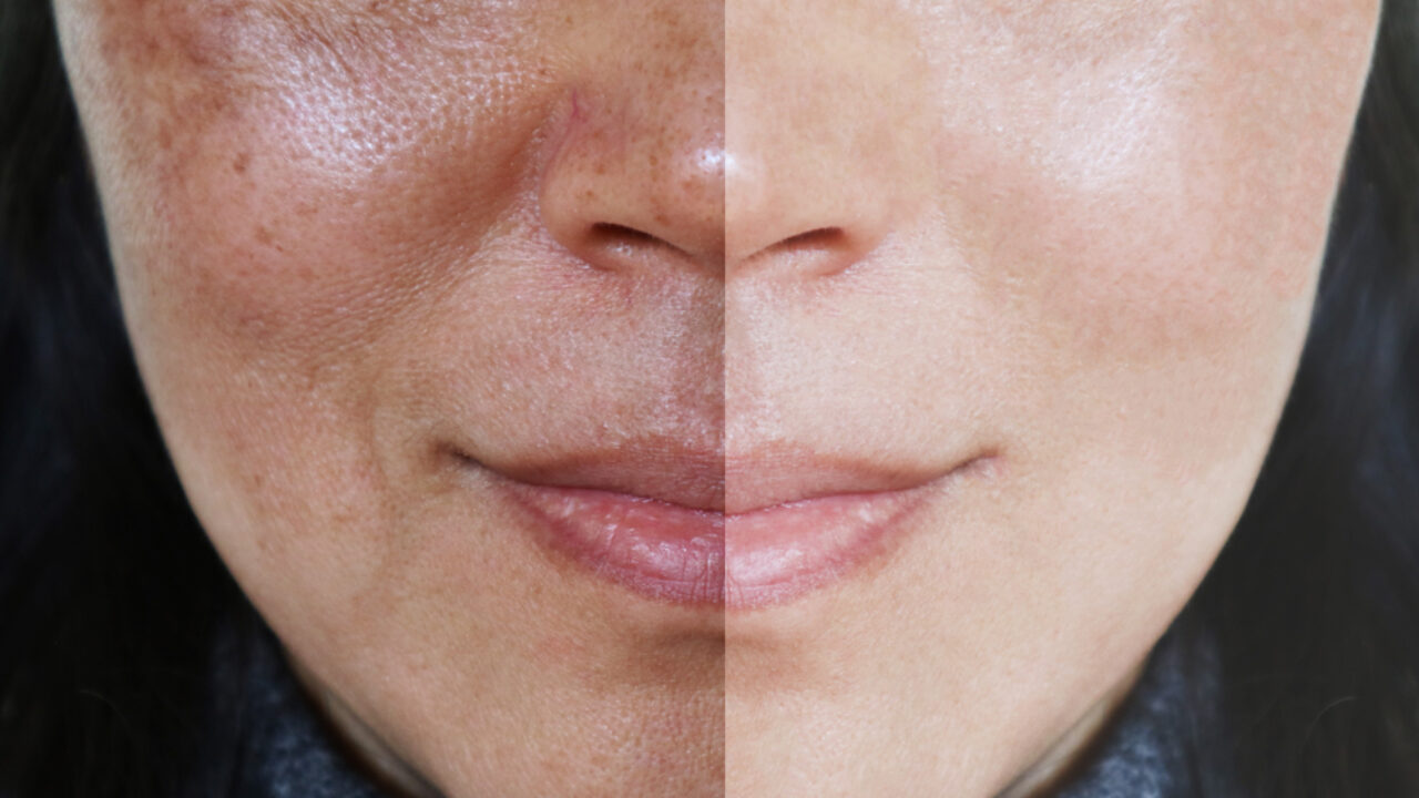 Dermatologist vs. DIY: Navigating Melasma Treatment Options