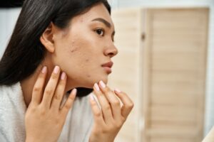 How to Prepare for Your Same-Day Acne Appointment in Milton