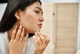 How to Prepare for Your Same-Day Acne Appointment in Milton