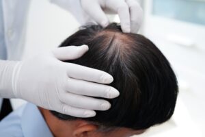 Effective Hair Loss Treatments in Randolph, MA: Local Specialist for Lasting Results