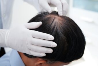 Effective Hair Loss Treatments in Randolph, MA: Local Specialist for Lasting Results