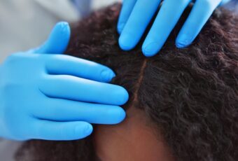 Q & A With the Top-Rated African-American Hair Loss Specialist Serving Newton, MA