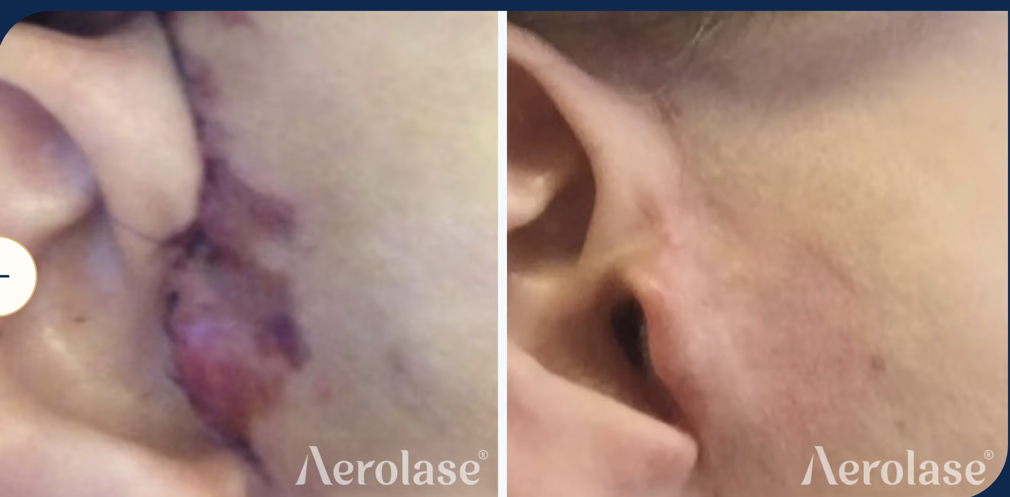 ERA Elite Ear