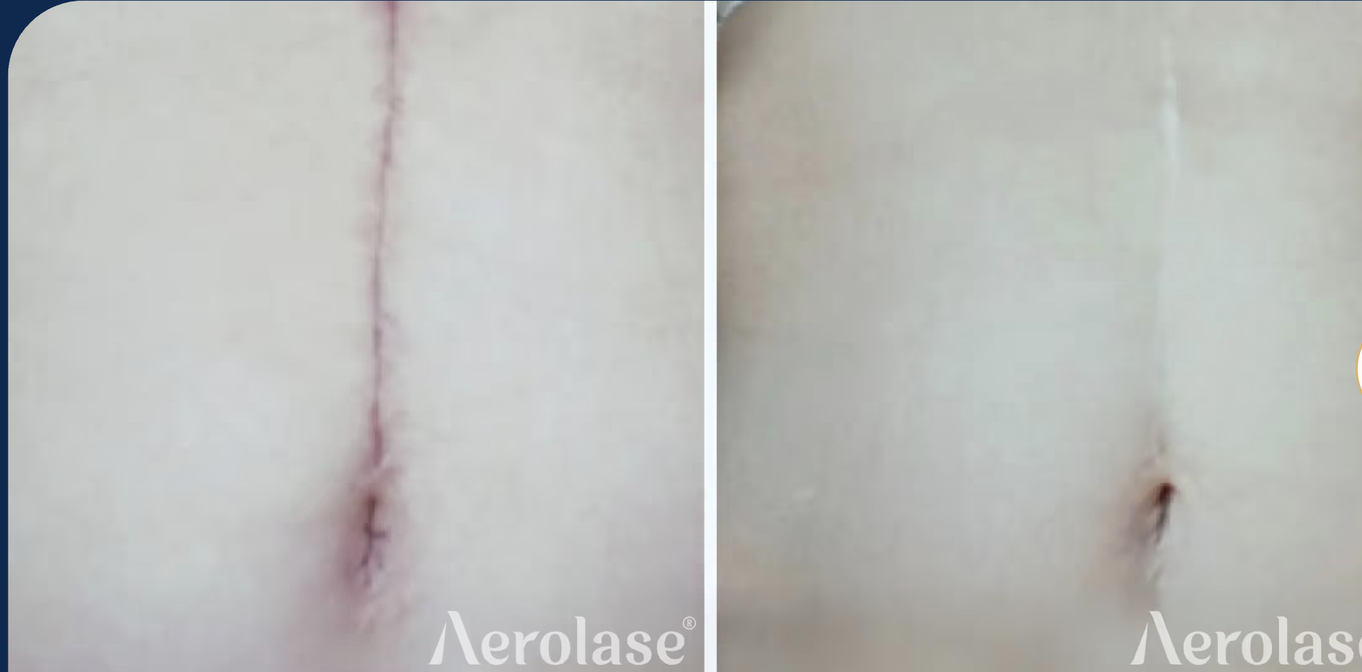 ERA Elite Stomach