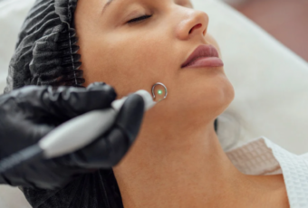 treatment with scar laser in Milton and Dedham Massachusetts