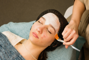 acne scar treatment MA