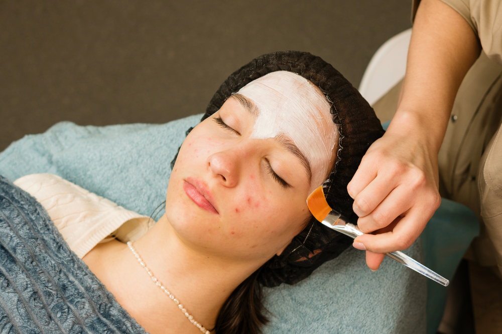 acne scar treatment MA