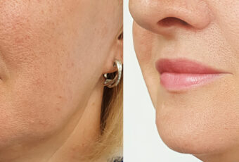 PRX-T33 Peel in Milton, Massachusetts