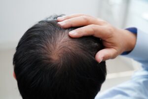 man suffering from hair loss in Roslindale MA