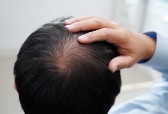 man suffering from hair loss in Roslindale MA