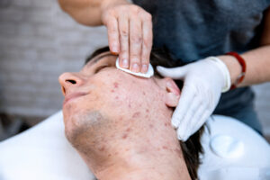 cystic acne treatment Braintree MA