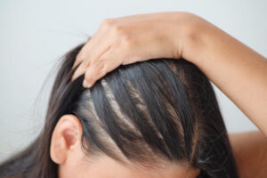 woman experiencing female hair loss in Quincy MA