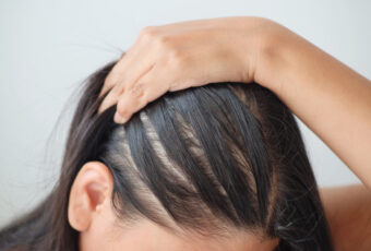 woman experiencing female hair loss in Quincy MA