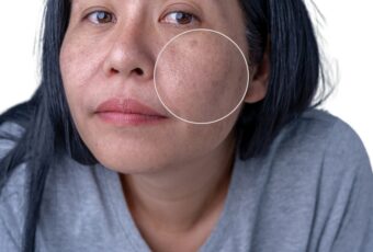 a woman who needs to treat uneven skin tones near Boston