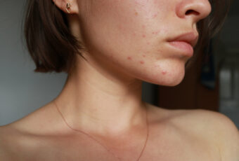woman suffering from adult acne in Boston