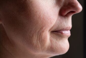 woman with poorly textured skin near Boston