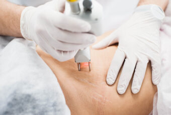 Laser Skin Resurfacing Near Boston