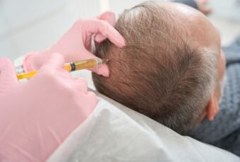 PRP for hair loss in Quincy MA