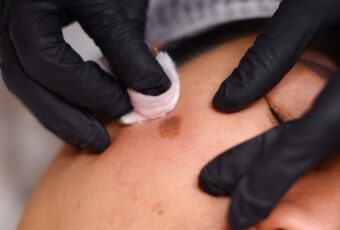 dark spot removal near Hingham MA