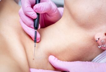 remove skin tags near Boston
