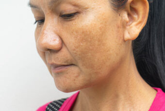 woman with melasma in Stoughton MA