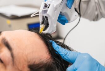 man getting PRP for hair loss near Stoughton