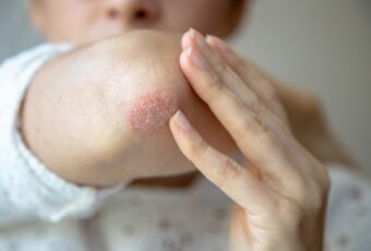 dry flaky patches on skin