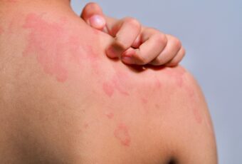rash that won't go away on its own